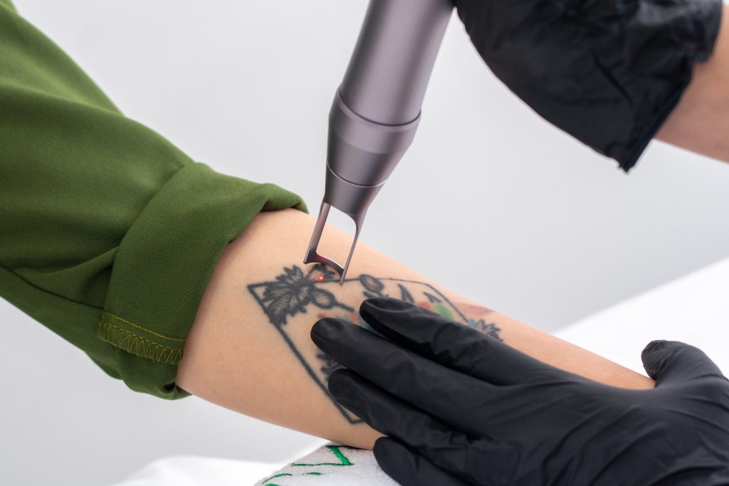 laser tattoo removal treatments